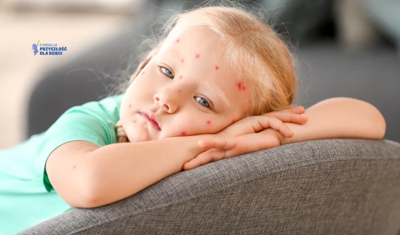 Ospa w przedszkolu co robić? Jak chronić dziecko i uniknąć problemów